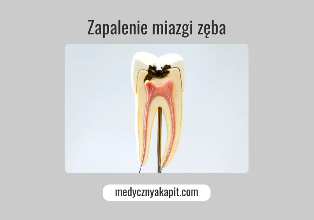 Zapalenie miazgi zęba - objawy, leczenie, ratunek dla zęba