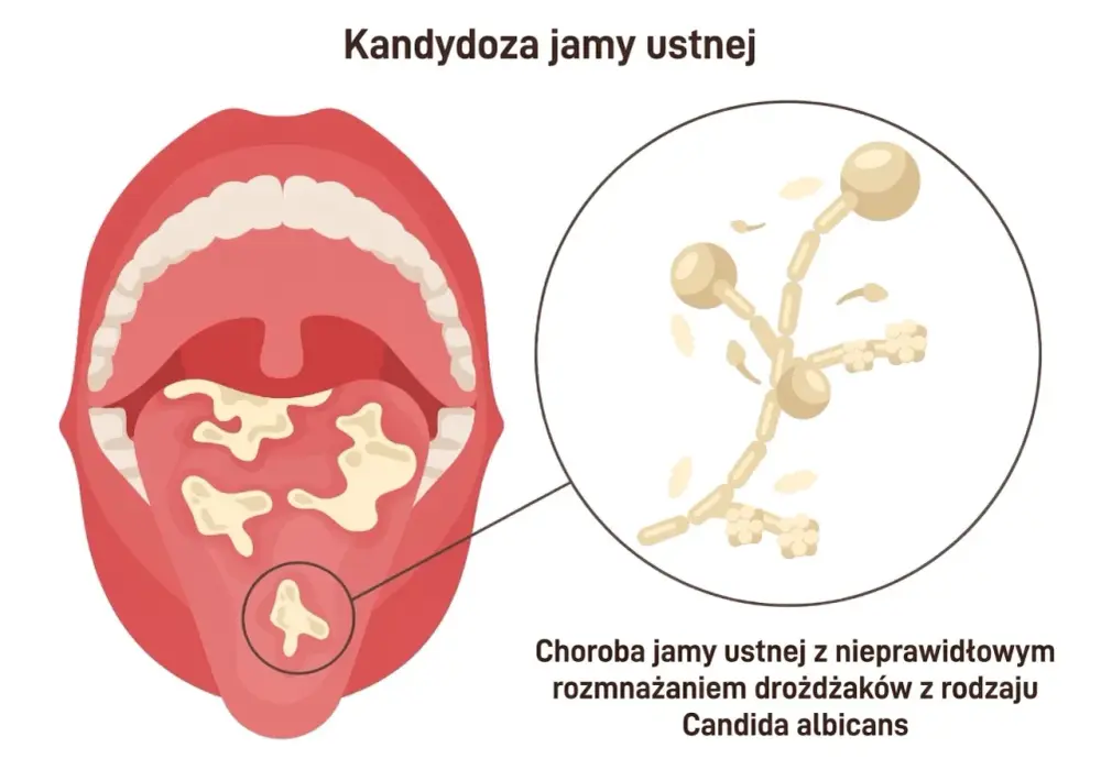 Pleśniawki w jamie ustnej - objawy, leczenie i profilaktyka