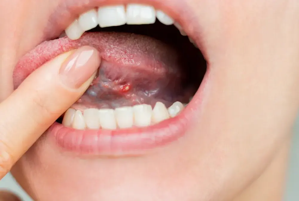 Ból i obrzęk pod językiem - Kiedy do dentysty?