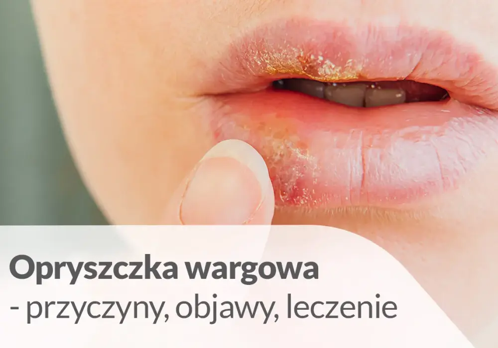 Opryszczka na ustach - Ile trwa i jak skrócić gojenie?