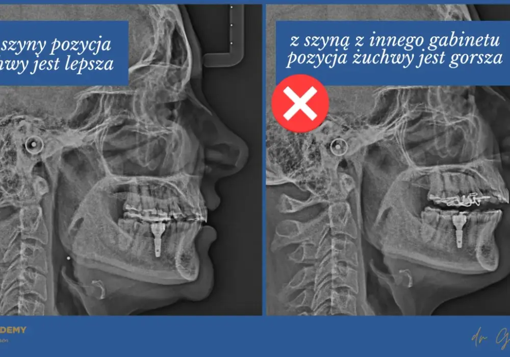 Szyna na staw skroniowo-żuchwowy - Kiedy naprawdę pomaga?