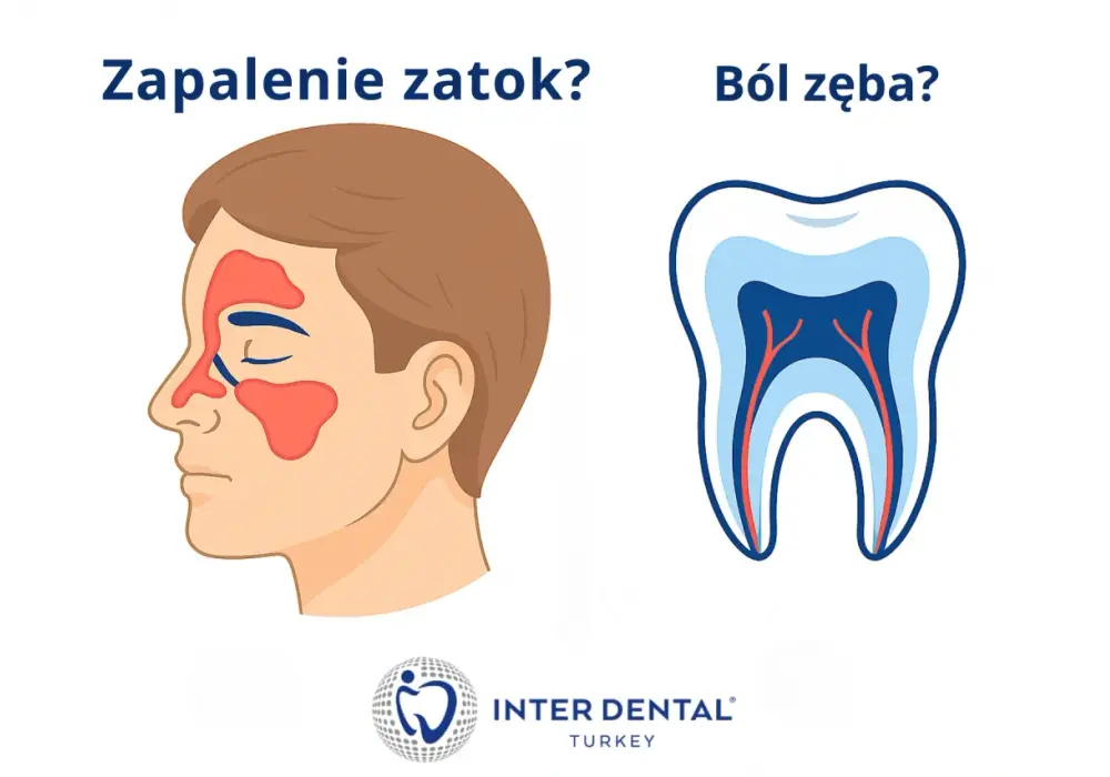 Zapalenie zatok od zęba - Jak rozpoznać i co robić?