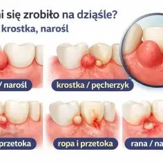 Guzek, krostka, narośl, ropa, przetoka lub rana w jamie ustnej na dziąśle przy zębach.