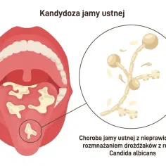 Ilustracja przedstawia jamę ustną z białymi nalotami na języku i podniebieniu, wskazującymi na kandydozę. Powiększony fragment ukazuje drożdżaki Candida albicans.