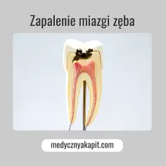 Model zęba ukazujący próchnicę sięgającą miazgi, co prowadzi do zapalenia miazgi.