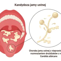 Obraz przedstawia jamę ustną z białymi nalotami, które mogą być objawem pleśniawek. Powiększony fragment pokazuje drożdżaki Candida albicans.