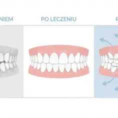 Przed leczeniem krzywe zęby, po leczeniu proste, a retencja to aparat utrzymujący efekt.