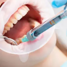 Jak długo trzyma znieczulenie od dentysty? Poznaj fakty i czas działania