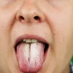 Popękany język z białym nalotem, widoczne zęby i usta.