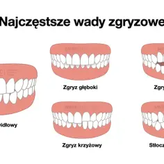Ilustracja pokazuje różne wady zgryzu: prawidłowy, głęboki, otwarty, krzyżowy i stłoczenia zębów. Każdy przykład inaczej zgryz pokazuje problem.
