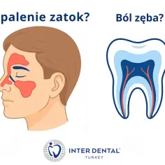 Zapalenie zatok od zęba? Ilustracja pokazuje twarz z zaznaczonymi zatokami i przekrój zęba.
