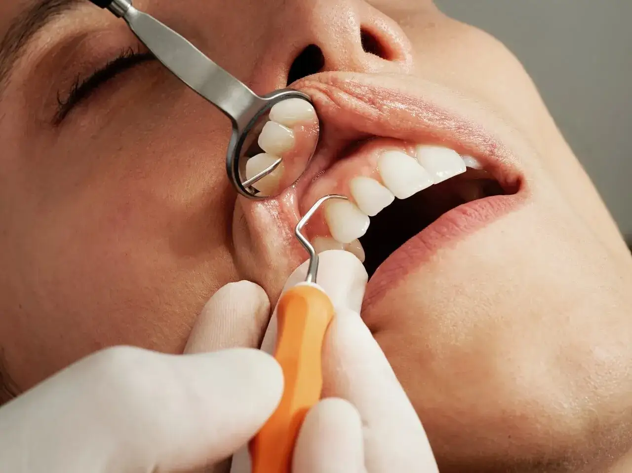 Złamany ząb czarny w środku, badany przez dentystę.
