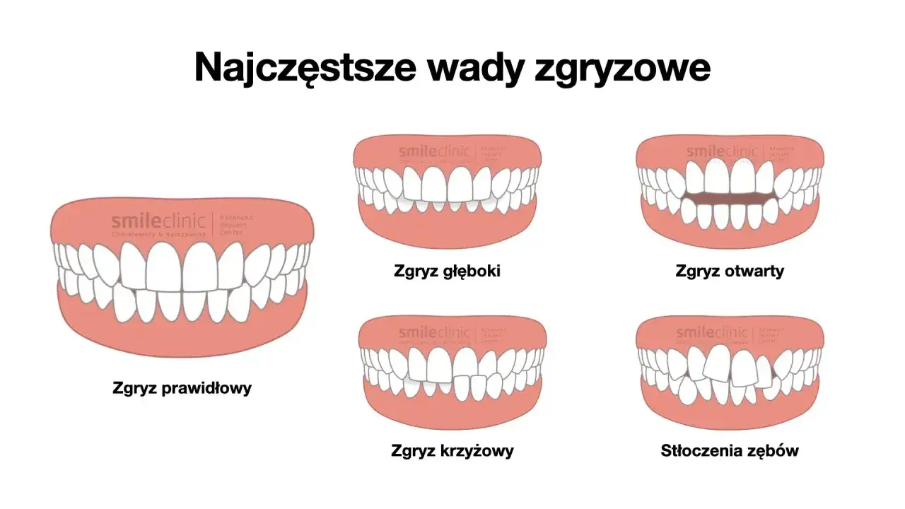 Ilustracja pokazuje różne wady zgryzu: prawidłowy, głęboki, otwarty, krzyżowy i stłoczenia zębów. Każdy przykład prezentuje inaczej ustawione zęby.