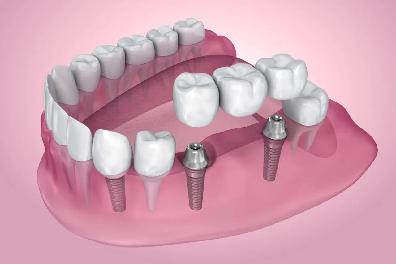 Widok zębów z implantami i mostkiem. Implanty stomatologiczne podtrzymują sztuczne zęby, tworząc naturalny uśmiech.