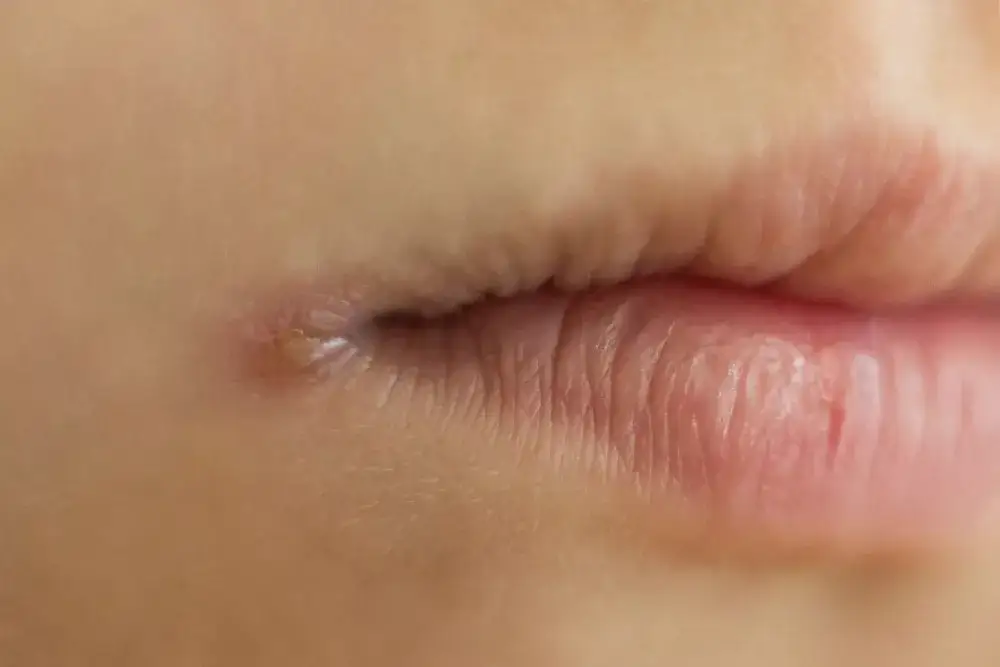 Zdjęcie Czy z zajadami można iść do dentysty? Co warto wiedzieć przed wizytą