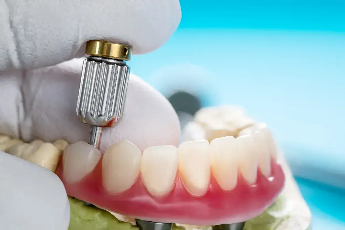 Precyzyjne dopasowanie protezy acetalowej przez technika dentystycznego.
