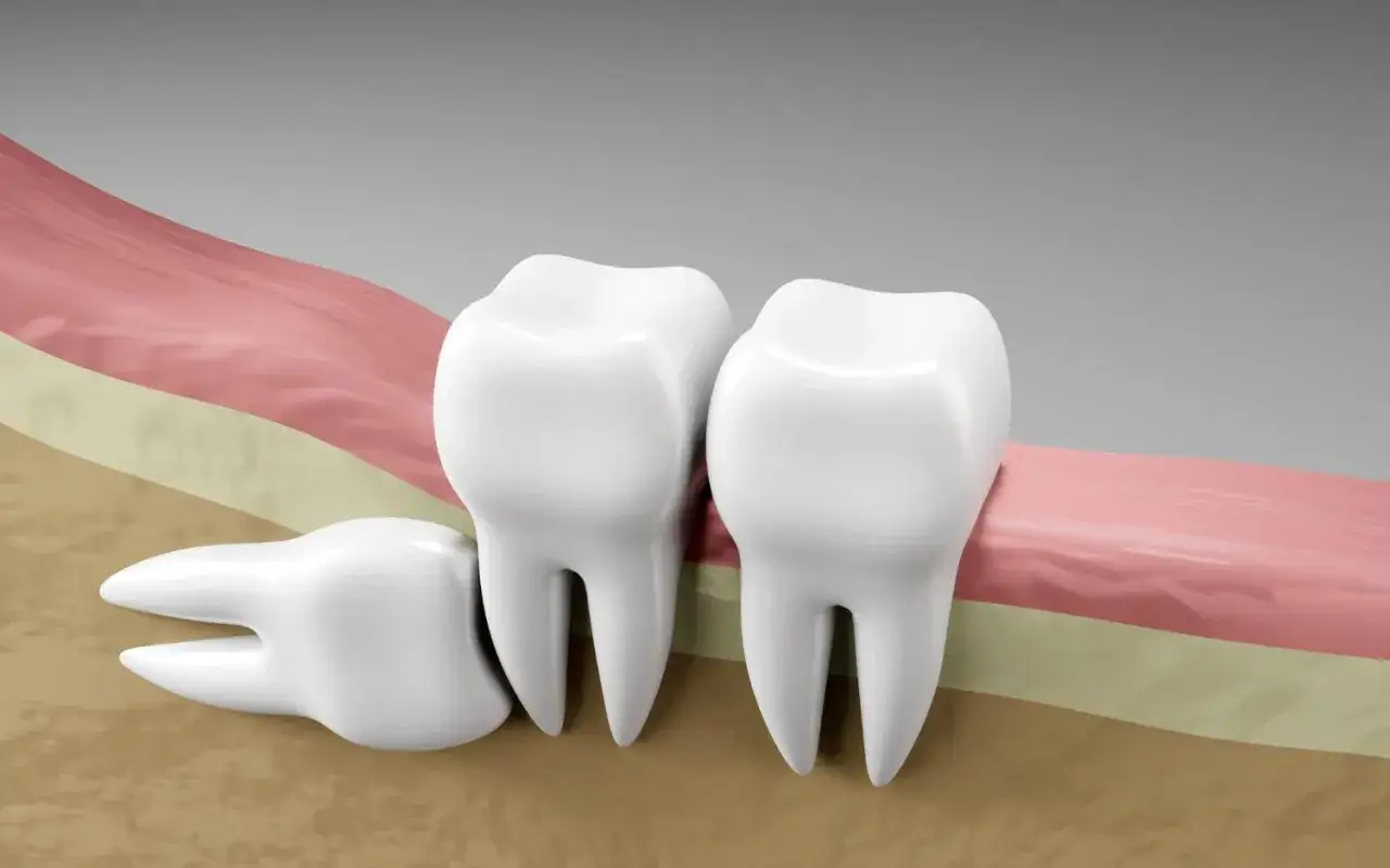 Ząb 18, czyli ósemka, leży obok dwóch innych zębów, częściowo ukryty.