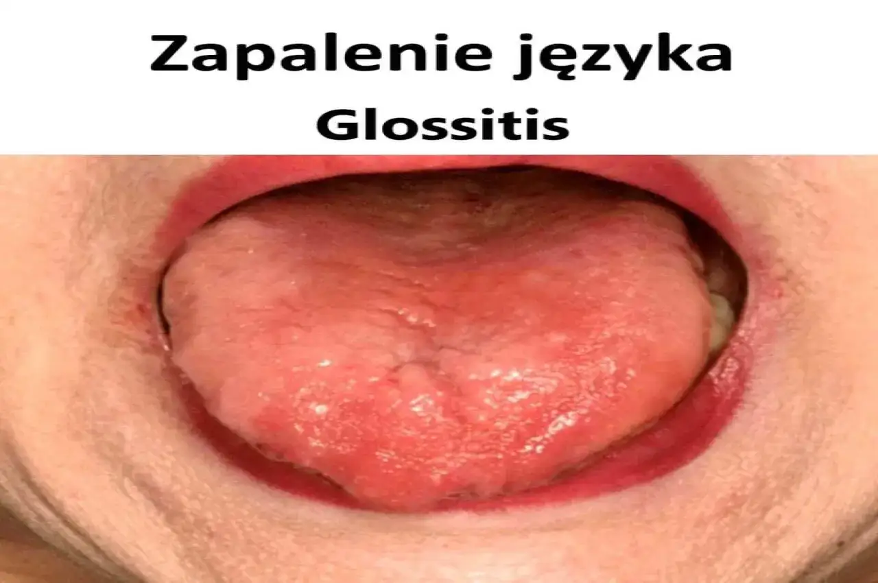 Zapalenie języka (glossitis) – zaczerwieniony, opuchnięty język. Szukasz leki bez recepty na zapalenie języka?