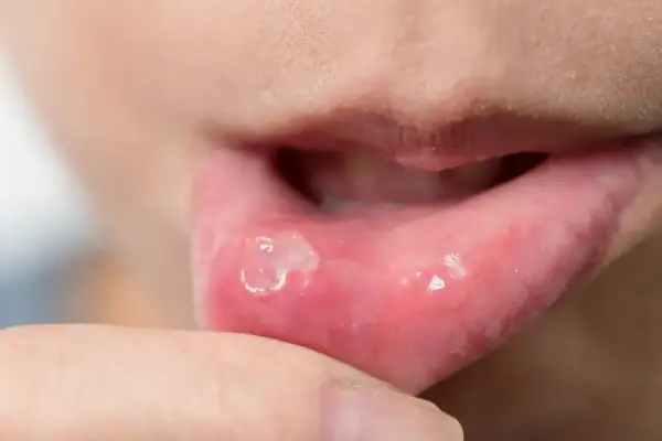Torbiel śluzowa w jamie ustnej - kiedy trzeba iść do dentysty?