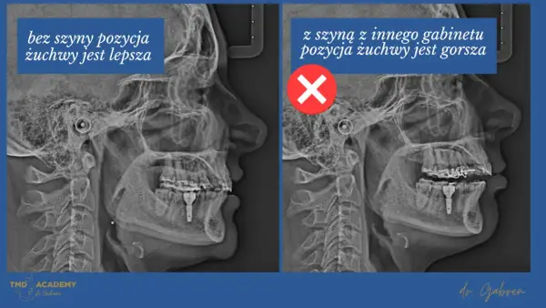 Szyna na staw skroniowo-żuchwowy - Kiedy naprawdę pomaga?