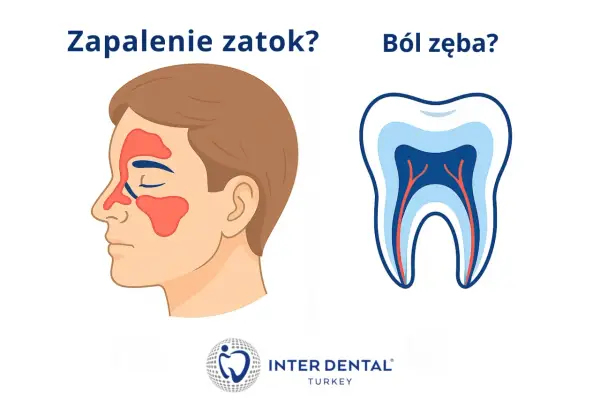 Zapalenie zatok od zęba - Jak rozpoznać i co robić?