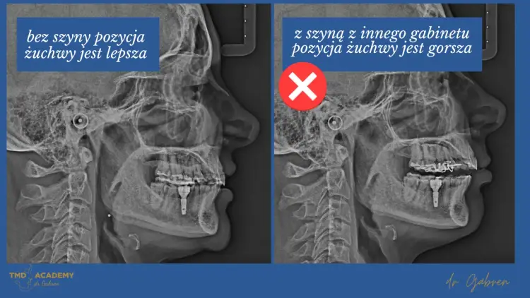 Szyna na staw skroniowo-żuchwowy - Kiedy naprawdę pomaga?